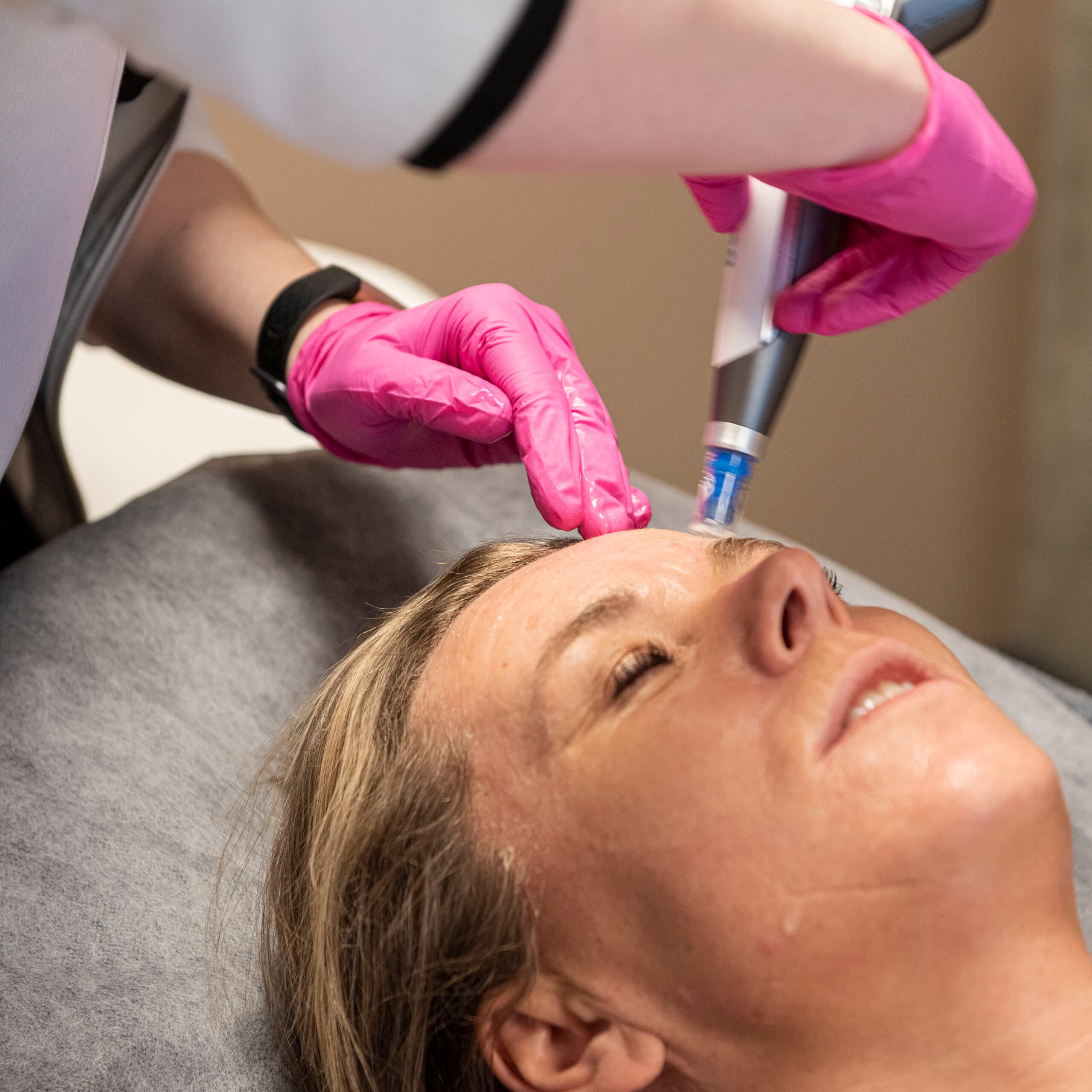 Microneedling